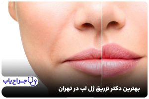بهترین دکتر تزریق ژل لب در تهران