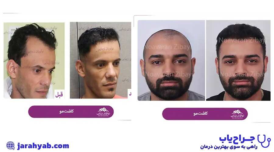 نمونه کار کلینیک کاشت مو نوآوران زیبایی (Noavarane Zibayi Clinic)