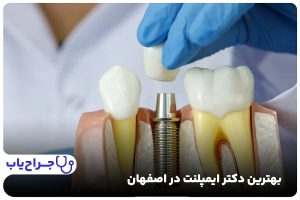 بهترین متخصص ایمپلنت در اصفهان